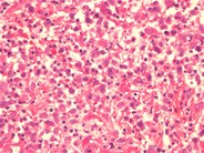 Primary Cutaneous Anaplastic Large Cell Lymphoma - 3.