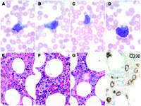 Circulating CD30-positive T-cell lymphoma with anaplastic morphology