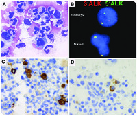 ALK-positive anaplastic large-cell lymphoma with marked leukemoid reaction and hemophagocytic lymphohistiocytosis