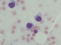 Plasma cells with Auer-rod like inclusions 2