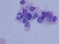 Histiocytes with Auer-rod like inclusions 2