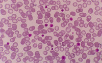 presence of giant platelets in peripheral blood sample 1