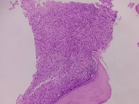 Bone marrow biopsy -granulomatous inflammation low power