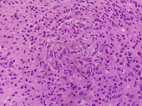 Bone marrow -epitheliod granuloma