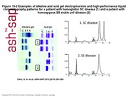 Alkaline and acid gel electrophoresis and HPLC patterns for a patient with SC disease and SS disease