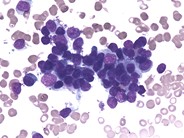 Hemophagocytic lymphohistiocytosis – reactive - 2.