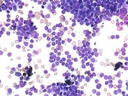 Hemophagocytic lymphohistiocytosis – reactive - 4.