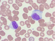 Infectious mononucleosis - 2.