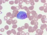 Infectious mononucleosis - 4.