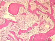 Metastatic prostate carcinoma - 1.