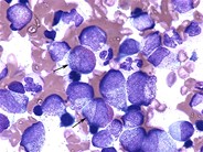 Left shifted myelopoiesis with toxic granulation - 2.