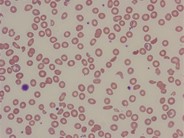 Microangiopathic hemolytic anemia secondary to artifical aortic valve malfunction - 2.