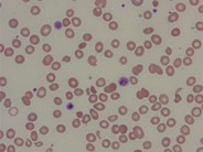 Microangiopathic hemolytic anemia secondary to artifical aortic valve malfunction - 3.