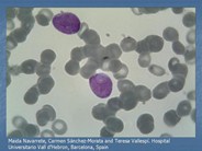 Blast cell with nucleus Cup-like in an AML with mutated NPM