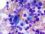 Plasma cell myeloma - Russell bodies