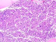 Marrow findings in JMML - 3.