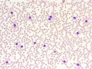 Sezary syndrome - peripheral smear - 1.