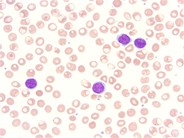 Sezary syndrome - peripheral smear - 3.