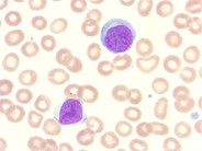 Sezary syndrome - peripheral smear - 4.