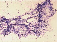 Radiation effect - bone marrow aspirate - 1.