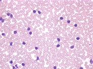 T-cell prolymphocytic leukemia - 1.