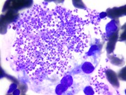 Histoplasma capsulatum in macrophage in bone marrow - 2.