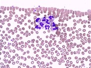 Neutrophil clumping in peripheral blood