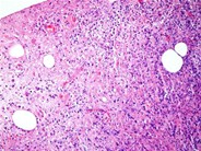 Herpes simplex lymphadenitis - 1.