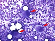 Dysplastic megakaryocytes - 1.