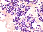 Waldenström’s macroglobulinemia: bone marrow aspirate - 1.