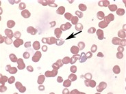 Basophilic stippling - 1.