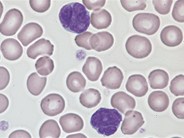 Adult T-cell leukemia / lymphoma