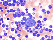 Primary effusion lymphoma - 2.