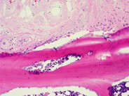 Amyloidosis - 1.