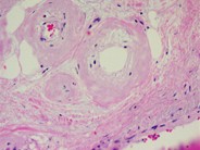 Amyloidosis - 2.