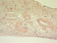 Amyloidosis - 3.