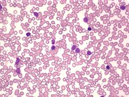 Marginal zone lymphoma: leukemic phase - 1.