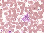 Other Name Of Essential Thrombocythemia