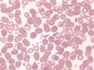 Essential thrombocythemia: peripheral smear - 2.