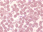 Essential thrombocythemia: peripheral smear - 2.