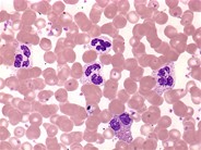 Essential thrombocythemia: peripheral smear - 3.