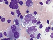 Anaplastic large cell lymphoma - bone marrow aspirate - 4.