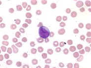 AML with maturation - 2.