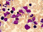 blastic plasmacytic dendritic cell neoplasm