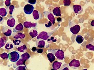 blastic plasmacytic dendritic cell neoplasm