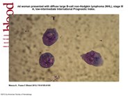 Large B-cell non-Hodgkin lymphoma relapsing with meningeal localization