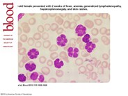 Flower cells of leukemia