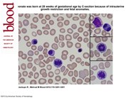 Hydrops Fetalis due to CMV