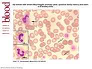 May-Hegglin anomaly