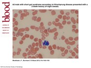 Yeast-like intraleukocytic inclusions in a peripheral smear